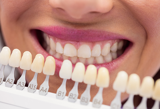 Lentes de Contato Dental