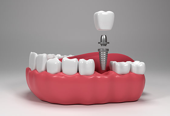Implantes Dentários