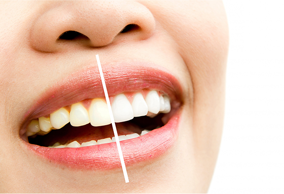 Clareamento Dental