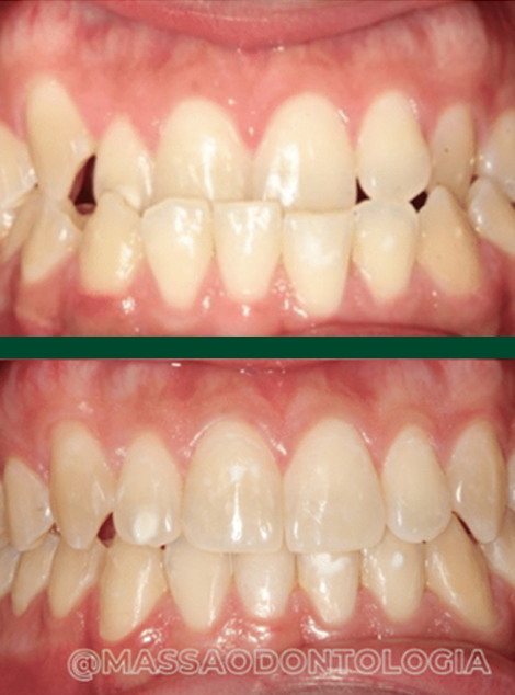 Antes e depois de paciente da Massa Odontologia
