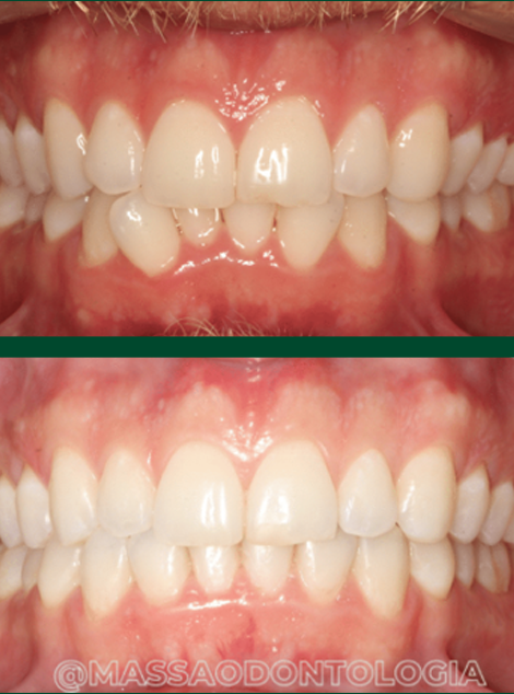 Antes e depois de paciente da Massa Odontologia