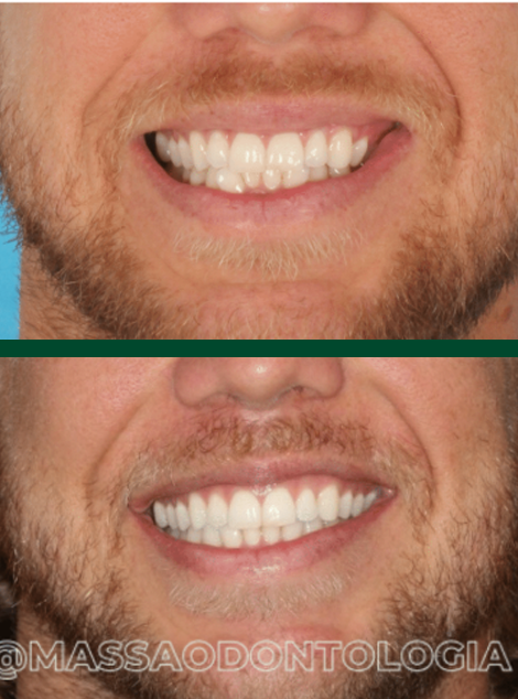 Antes e depois de paciente da Massa Odontologia
