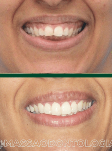 Antes e depois de paciente da Massa Odontologia