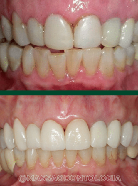 Antes e depois de paciente da Massa Odontologia