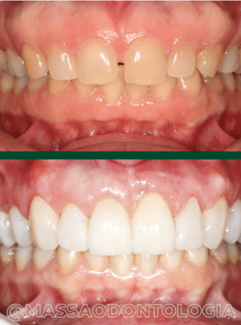 Antes e depois de paciente da Massa Odontologia