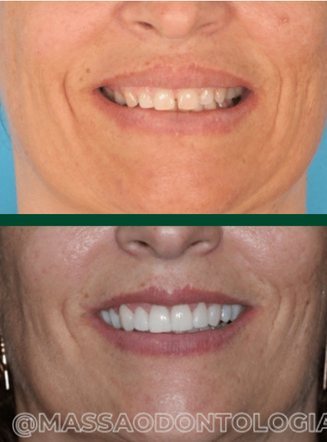 Antes e depois de paciente da Massa Odontologia