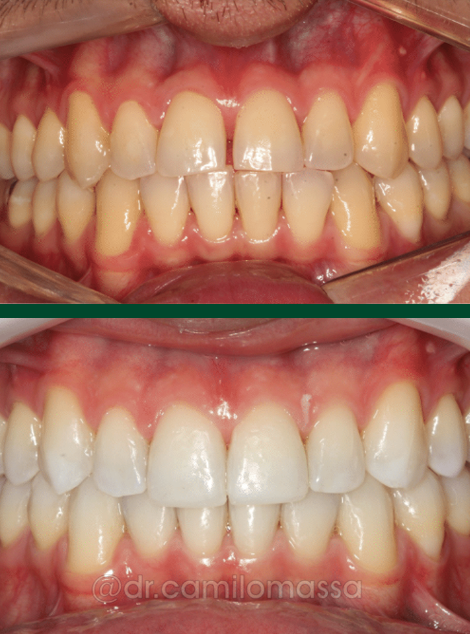 Antes e depois de paciente da Massa Odontologia