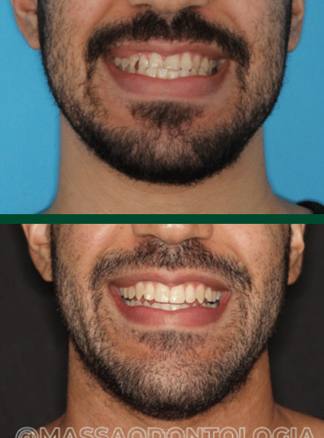 Antes e depois de paciente da Massa Odontologia