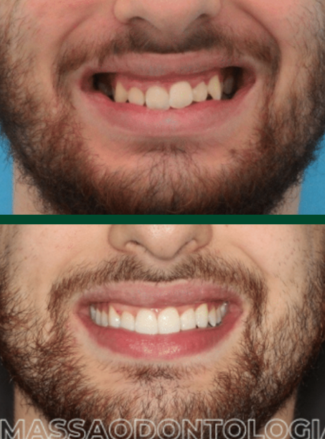 Antes e depois de paciente da Massa Odontologia