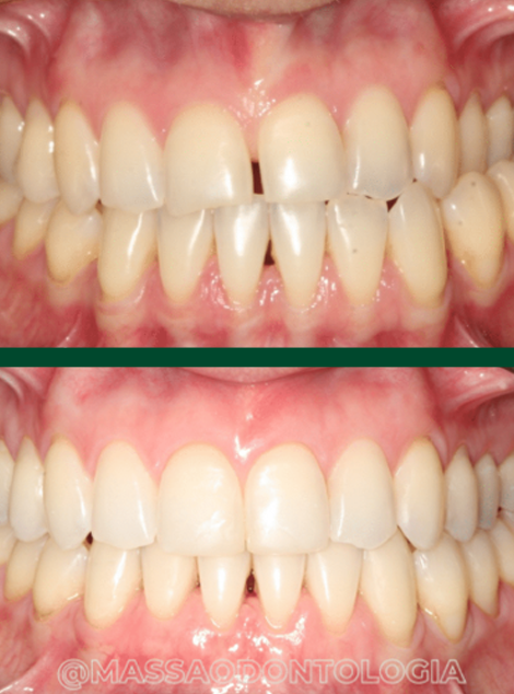 Antes e depois de paciente da Massa Odontologia