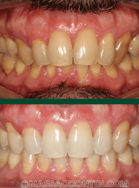Antes e depois de paciente da Massa Odontologia