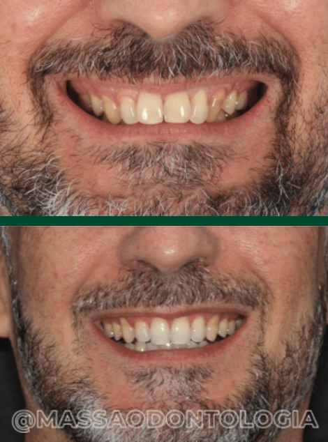 Antes e depois de paciente da Massa Odontologia