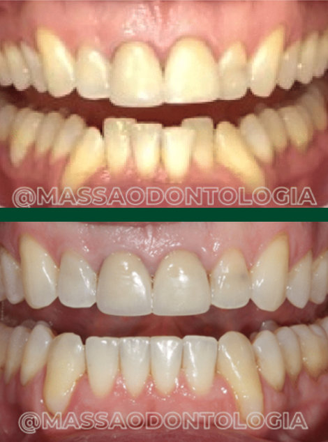 Antes e depois de paciente da Massa Odontologia