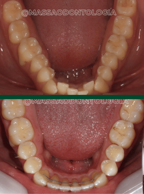 Antes e depois de paciente da Massa Odontologia