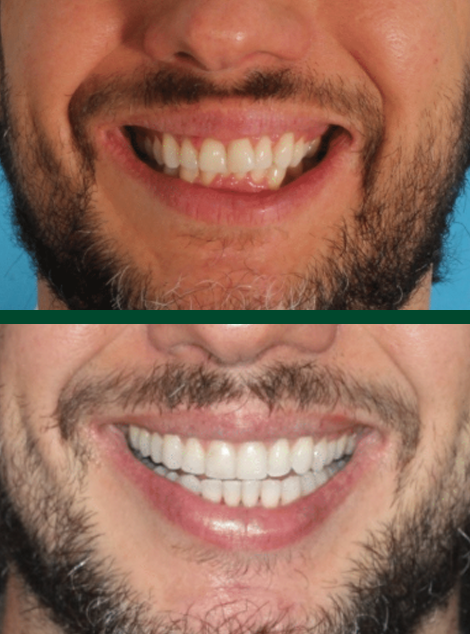 Antes e depois de paciente da Massa Odontologia