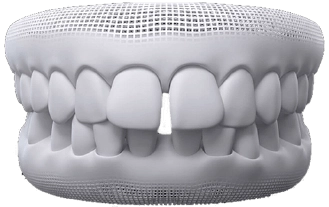 Antes, Diastema
